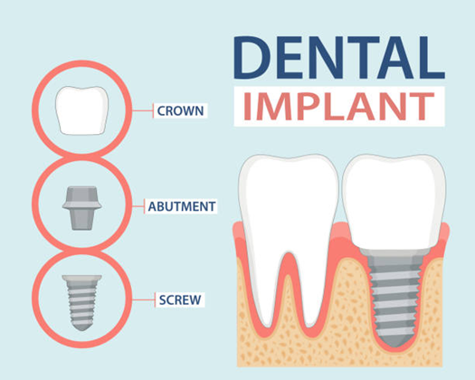 Dental Implant Detail