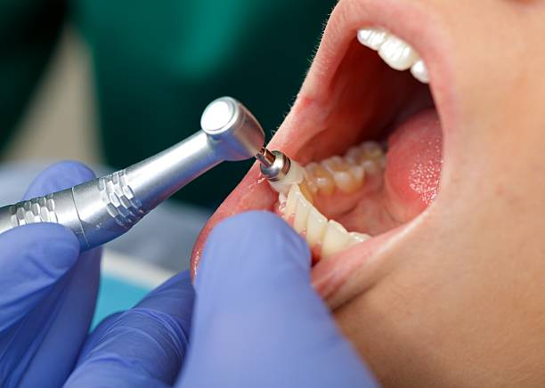 Single Tooth Implant