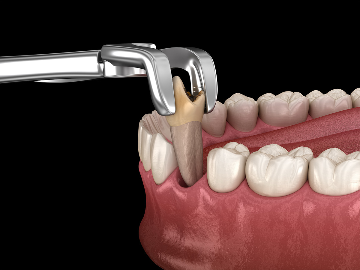 Keyhole Implants