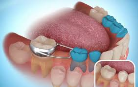 TAD Implants