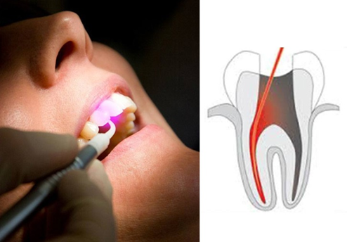 Laser Root Canal