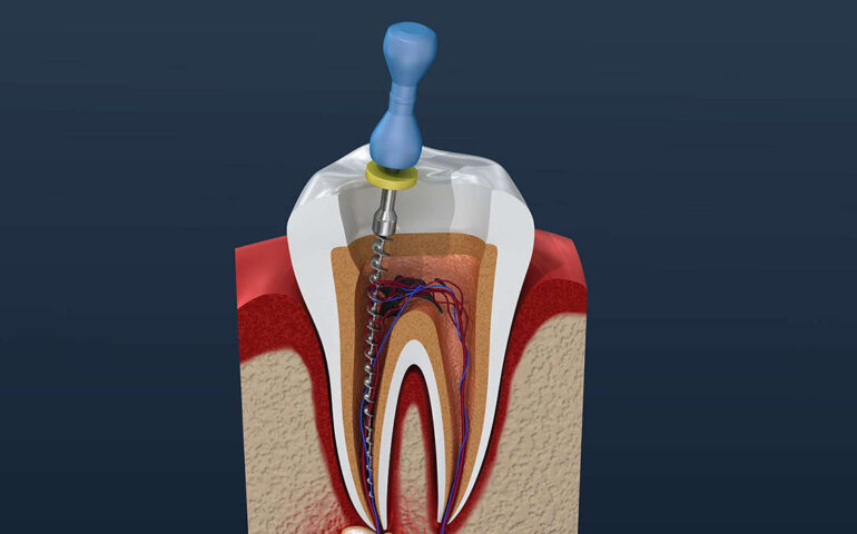 Advanced Endodontics