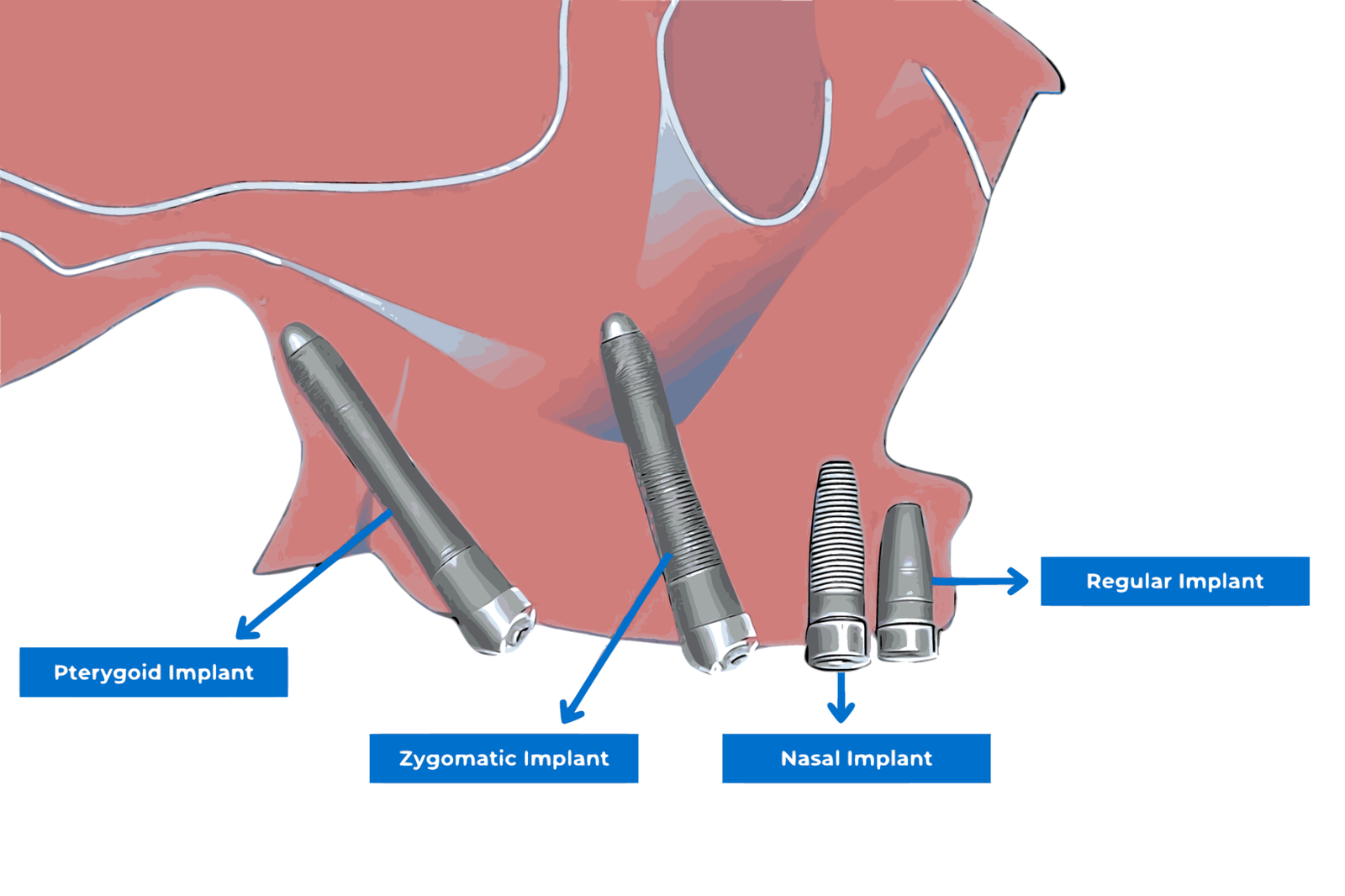 Zygomatic Implants